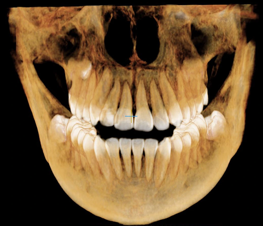 Visualización dental del material publicitario de MaxiDental